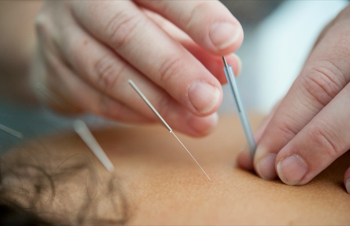 Acupuncture needles being placed during a treatment at Sunshine Wellness in Oakville