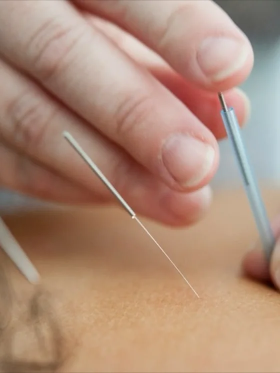 Acupuncture treatment at Sunshine Wellness in Oakville